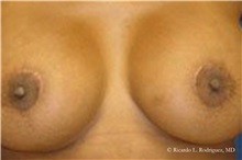 Breast Lift After Photo by Ricardo Rodriguez, MD; Lutherville-Timonium, MD - Case 32467