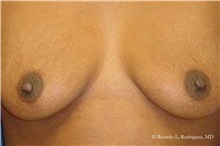 Breast Lift Before Photo by Ricardo Rodriguez, MD; Lutherville-Timonium, MD - Case 32467