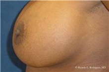 Breast Lift After Photo by Ricardo Rodriguez, MD; Lutherville-Timonium, MD - Case 32468