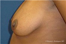 Breast Lift Before Photo by Ricardo Rodriguez, MD; Lutherville-Timonium, MD - Case 32468