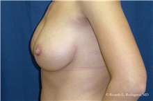 Breast Lift After Photo by Ricardo Rodriguez, MD; Lutherville-Timonium, MD - Case 32470