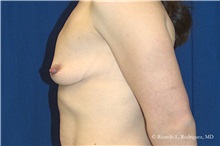 Breast Lift Before Photo by Ricardo Rodriguez, MD; Lutherville-Timonium, MD - Case 32470