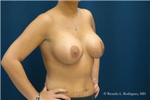 Breast Lift After Photo by Ricardo Rodriguez, MD; Lutherville-Timonium, MD - Case 32472