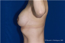 Breast Lift After Photo by Ricardo Rodriguez, MD; Lutherville-Timonium, MD - Case 32476