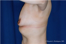 Breast Lift Before Photo by Ricardo Rodriguez, MD; Lutherville-Timonium, MD - Case 32476
