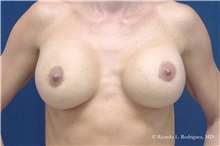 Breast Lift After Photo by Ricardo Rodriguez, MD; Lutherville-Timonium, MD - Case 32477