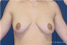 Breast Lift Before Photo by Ricardo Rodriguez, MD; Lutherville-Timonium, MD - Case 32477