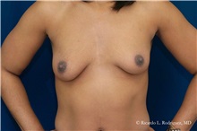 Breast Lift Before Photo by Ricardo Rodriguez, MD; Lutherville-Timonium, MD - Case 32479