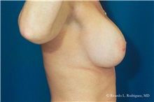 Breast Lift After Photo by Ricardo Rodriguez, MD; Lutherville-Timonium, MD - Case 32480