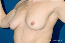 Breast Lift Before Photo by Ricardo Rodriguez, MD; Lutherville-Timonium, MD - Case 32480