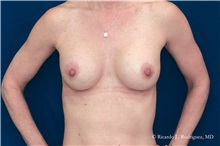 Breast Lift After Photo by Ricardo Rodriguez, MD; Lutherville-Timonium, MD - Case 32481
