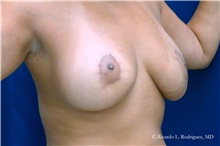Breast Lift After Photo by Ricardo Rodriguez, MD; Lutherville-Timonium, MD - Case 32482