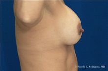Breast Lift After Photo by Ricardo Rodriguez, MD; Lutherville-Timonium, MD - Case 32483