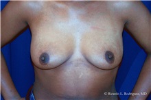 Breast Lift Before Photo by Ricardo Rodriguez, MD; Lutherville-Timonium, MD - Case 32485