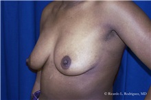 Breast Lift Before Photo by Ricardo Rodriguez, MD; Lutherville-Timonium, MD - Case 32485
