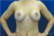 Breast Lift After Photo by Ricardo Rodriguez, MD; Lutherville-Timonium, MD - Case 32486