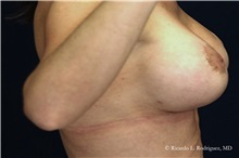 Breast Lift After Photo by Ricardo Rodriguez, MD; Lutherville-Timonium, MD - Case 32487