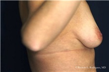 Breast Lift Before Photo by Ricardo Rodriguez, MD; Lutherville-Timonium, MD - Case 32487