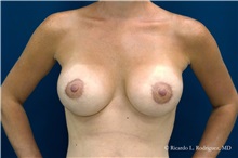 Breast Lift After Photo by Ricardo Rodriguez, MD; Lutherville-Timonium, MD - Case 32489