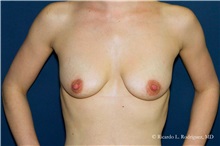Breast Lift Before Photo by Ricardo Rodriguez, MD; Lutherville-Timonium, MD - Case 32489