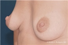 Breast Lift Before Photo by Ricardo Rodriguez, MD; Lutherville-Timonium, MD - Case 32490