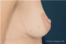 Breast Lift Before Photo by Ricardo Rodriguez, MD; Lutherville-Timonium, MD - Case 32490