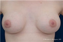 Breast Lift After Photo by Ricardo Rodriguez, MD; Lutherville-Timonium, MD - Case 32491