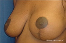 Breast Lift Before Photo by Ricardo Rodriguez, MD; Lutherville-Timonium, MD - Case 32492