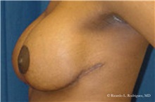 Breast Lift After Photo by Ricardo Rodriguez, MD; Lutherville-Timonium, MD - Case 32492