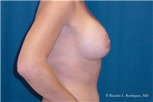 Breast Lift After Photo by Ricardo Rodriguez, MD; Lutherville-Timonium, MD - Case 32493
