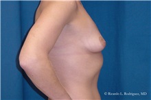 Breast Lift Before Photo by Ricardo Rodriguez, MD; Lutherville-Timonium, MD - Case 32493