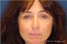 Brow Lift After Photo by Ricardo Rodriguez, MD; Lutherville-Timonium, MD - Case 32527
