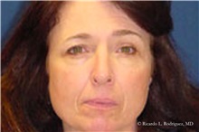 Brow Lift Before Photo by Ricardo Rodriguez, MD; Lutherville-Timonium, MD - Case 32527