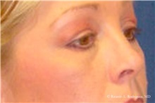 Brow Lift After Photo by Ricardo Rodriguez, MD; Lutherville-Timonium, MD - Case 32530