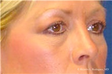 Brow Lift Before Photo by Ricardo Rodriguez, MD; Lutherville-Timonium, MD - Case 32530