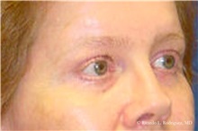 Brow Lift After Photo by Ricardo Rodriguez, MD; Lutherville-Timonium, MD - Case 32534