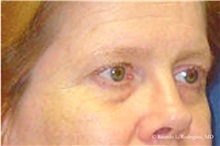 Brow Lift Before Photo by Ricardo Rodriguez, MD; Lutherville-Timonium, MD - Case 32534