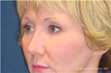 Brow Lift Before Photo by Ricardo Rodriguez, MD; Lutherville-Timonium, MD - Case 32535