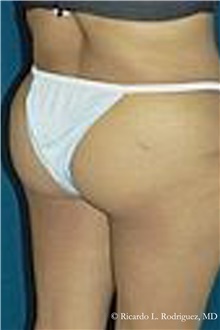 Buttock Lift with Augmentation After Photo by Ricardo Rodriguez, MD; Lutherville-Timonium, MD - Case 32537