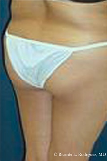 Buttock Lift with Augmentation Before Photo by Ricardo Rodriguez, MD; Lutherville-Timonium, MD - Case 32537