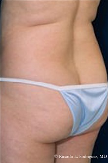 Buttock Lift with Augmentation Before Photo by Ricardo Rodriguez, MD; Lutherville-Timonium, MD - Case 32538