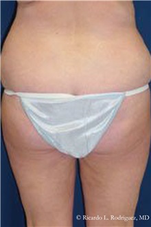Buttock Lift with Augmentation Before Photo by Ricardo Rodriguez, MD; Lutherville-Timonium, MD - Case 32539