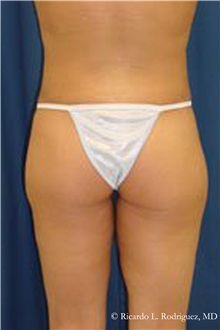 Buttock Lift with Augmentation After Photo by Ricardo Rodriguez, MD; Lutherville-Timonium, MD - Case 32540