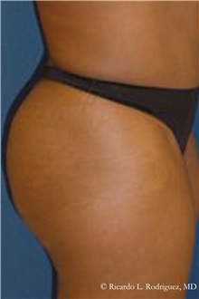 Buttock Lift with Augmentation After Photo by Ricardo Rodriguez, MD; Lutherville-Timonium, MD - Case 32541