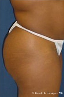 Buttock Lift with Augmentation Before Photo by Ricardo Rodriguez, MD; Lutherville-Timonium, MD - Case 32541