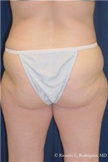 Buttock Lift with Augmentation Before Photo by Ricardo Rodriguez, MD; Lutherville-Timonium, MD - Case 32542
