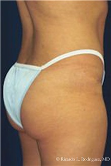 Buttock Lift with Augmentation After Photo by Ricardo Rodriguez, MD; Lutherville-Timonium, MD - Case 32543