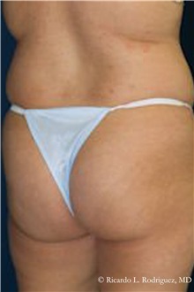 Buttock Lift with Augmentation Before Photo by Ricardo Rodriguez, MD; Lutherville-Timonium, MD - Case 32543