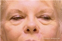 Eyelid Surgery Before Photo by Ricardo Rodriguez, MD; Lutherville-Timonium, MD - Case 32544