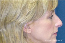 Eyelid Surgery After Photo by Ricardo Rodriguez, MD; Lutherville-Timonium, MD - Case 32545